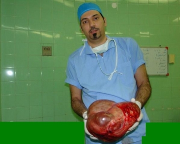 خروج غده 6 کیلویی از شکم زن بیمار در کنگان