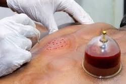 چه کسانی باید با مشاوره پزشک حجامت کنند
