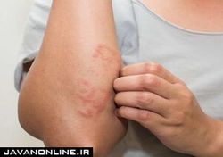 مشکلات پوست و مو ناشی از کرونا چه ویژگی دارند؟