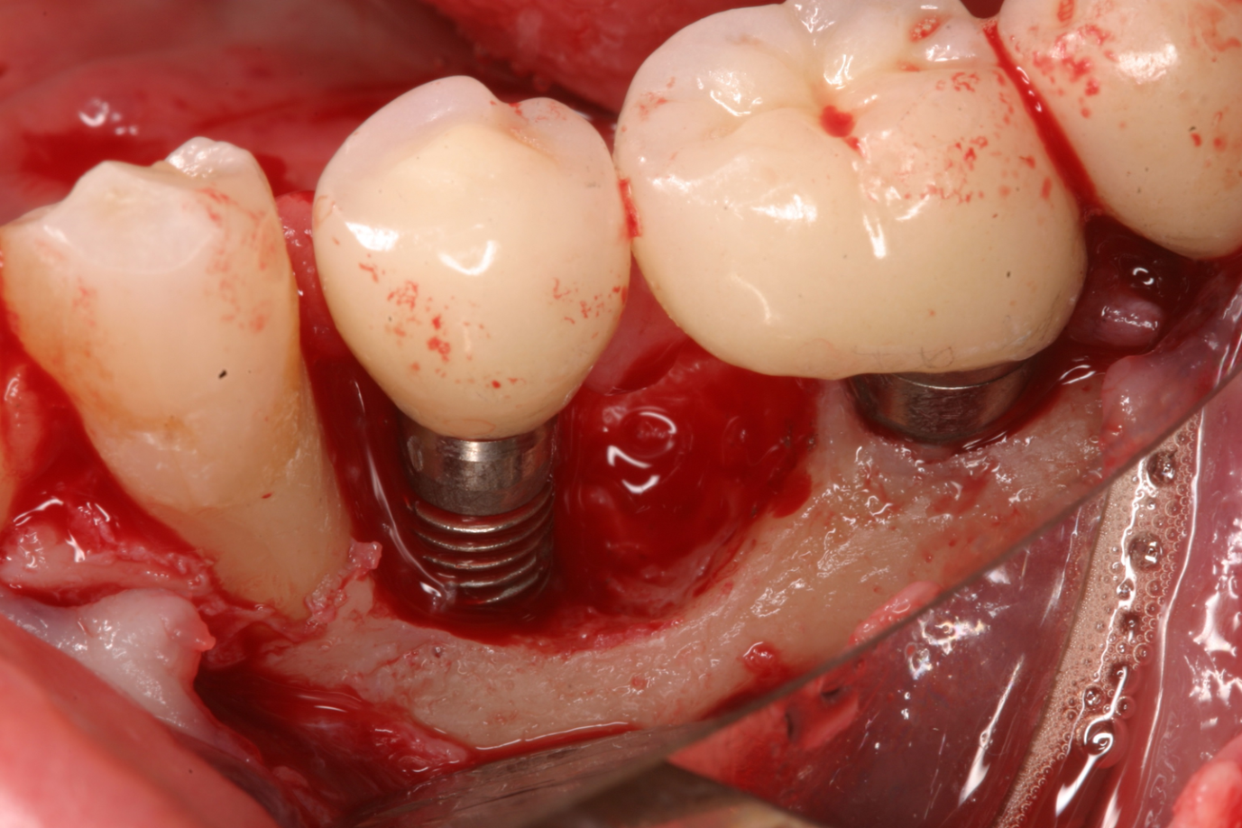 آشنایی با عوارض ایمپلنت دندان