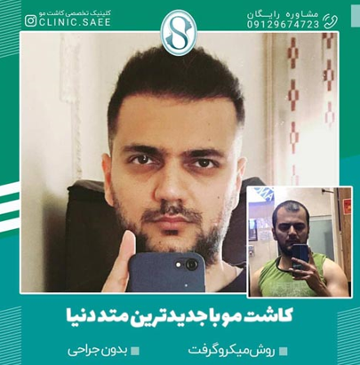 بهترین فصل برای کاشت مو چه زمانی است؟