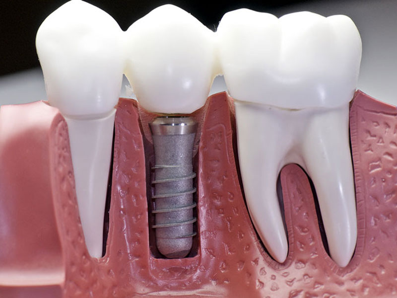 ایمپلنت دندان چیست؟ایمپلنت برای چه افرادی مناسب و برای چه افرادی نامناسب است؟