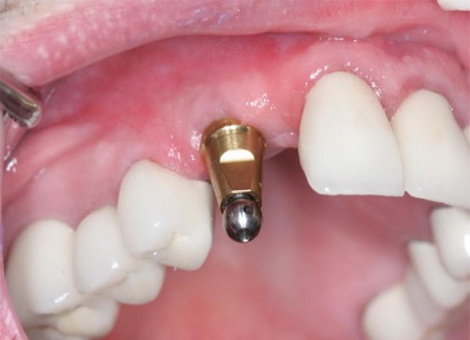 ایمپلنت دندان چیست؟ایمپلنت برای چه افرادی مناسب و برای چه افرادی نامناسب است؟