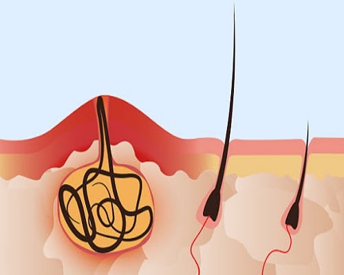 کیست مویی پایین کمر و پاسخ به همه سوالات شما درباره این بیماری