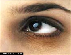 راهکار‌های ساده برای رفع سیاهی دور چشم
