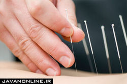 جایگاه طب سوزنی در فیزیوتراپی