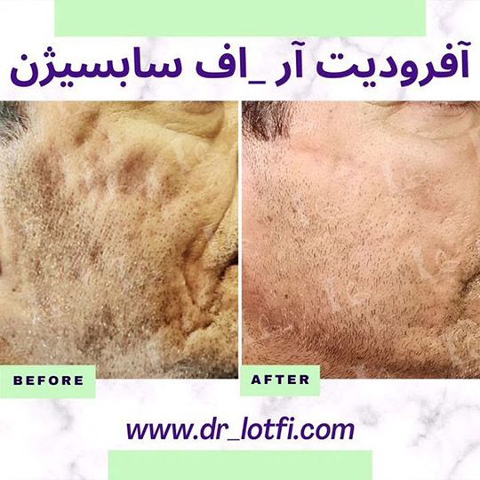 سریع ترین روش های از بین بردن جای جوش سریع ترین روش های از بین بردن جای جوش