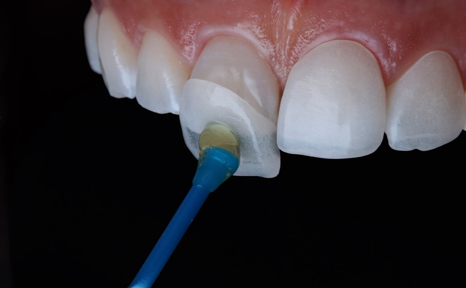 برای منظم کردن دندان ها ارتودنسی نامرئی بهتر است یا لمینت؟