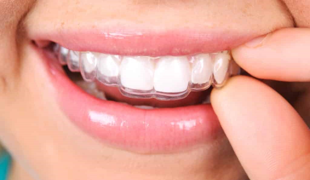 برای منظم کردن دندان ها ارتودنسی نامرئی بهتر است یا لمینت؟