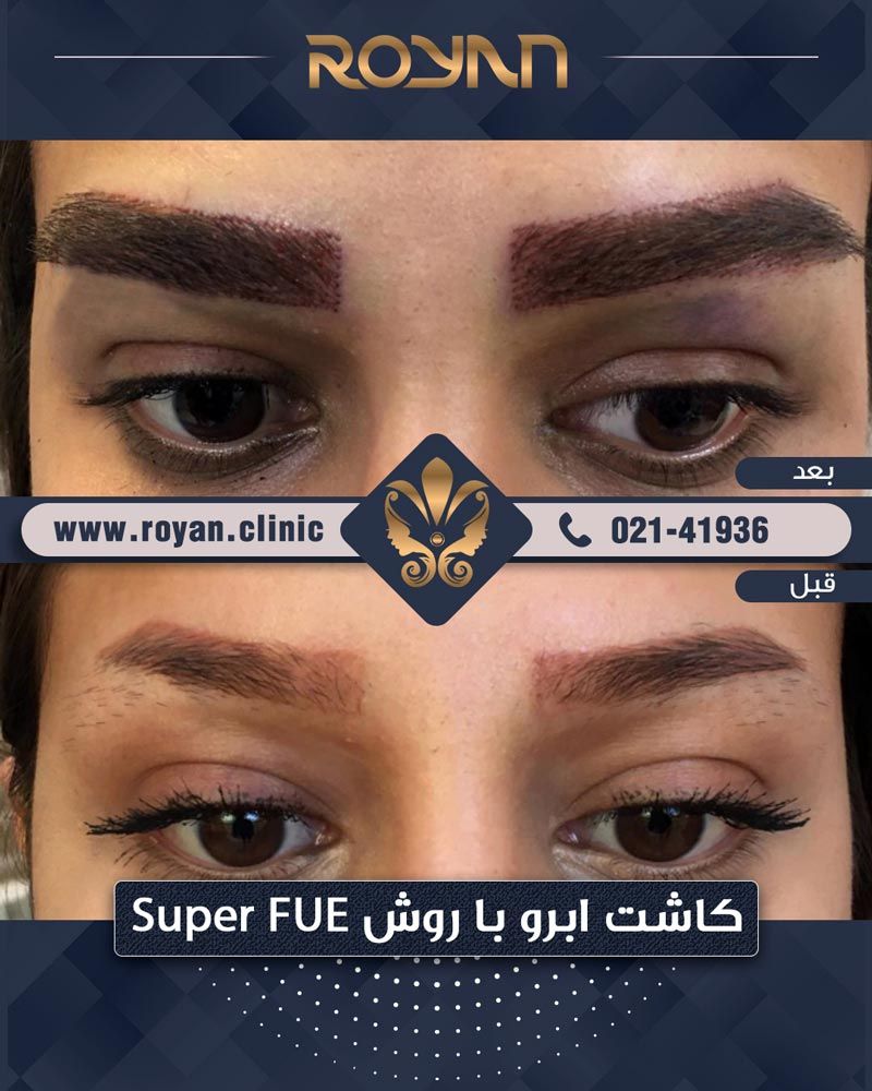 بهترین کلینیک و مرکز کاشت ابروی تهران کجا است؟ بهترین کلینیک و مرکز کاشت ابروی تهران کجا است؟