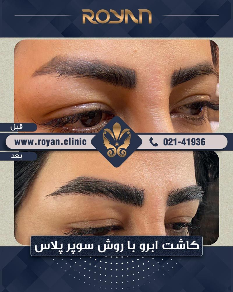 بهترین کلینیک و مرکز کاشت ابروی تهران کجا است؟ بهترین کلینیک و مرکز کاشت ابروی تهران کجا است؟