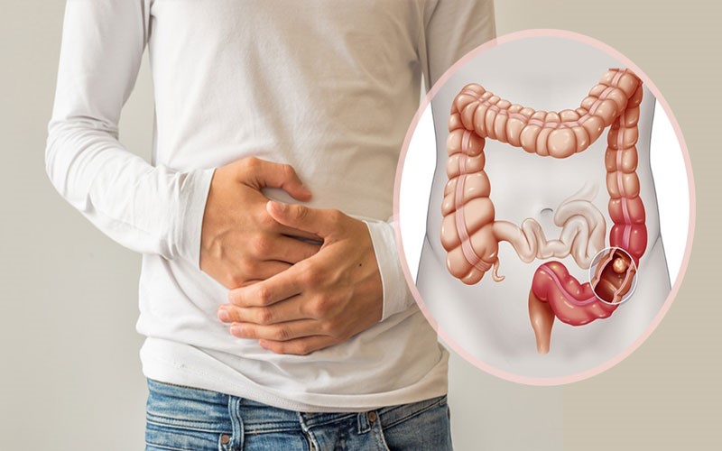 سرطان روده؛ یکی از شایع ترین مشکلات گوارشی سرطان روده؛ یکی از شایع ترین مشکلات گوارشی