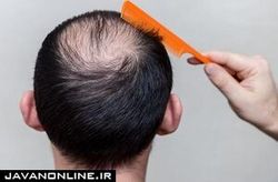 ارتباط ژن طاسی در مردان با افزایش خطر کرونا