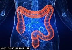 با این راهکار از سرطان روده بزرگ پیشگیری کنید