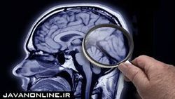 نتایج امیدوارکننده یک دارو برای درمان آلزایمر