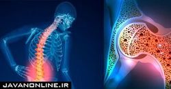 رابطه میان پوکی استخوان و دیابت