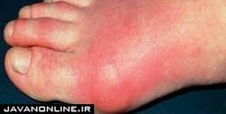 مهمترین نشانه ابتلا به «نقرس»
