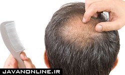 داروی درمان «ریزش موی» ایرانی مجوز مصرف گرفت
