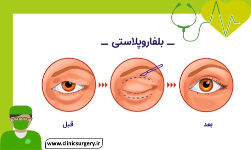 بهترین کرم ترمیم کننده جای زخم جراحی پلک یا بلفاروپلاستی