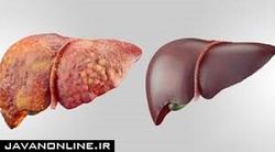 محقق ایرانی ژن تاثیرگذار در بیماری کبد چرب را شناسایی کرد