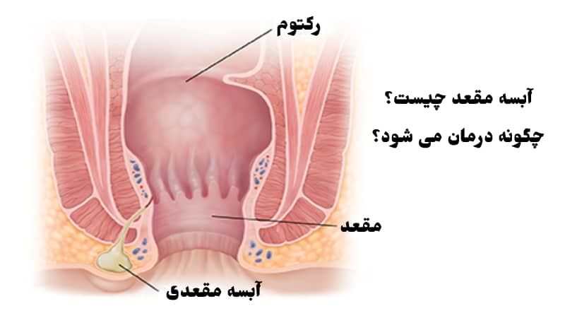 آیا آبسه مقعدی خطرناک است؟ +درمان و علائم