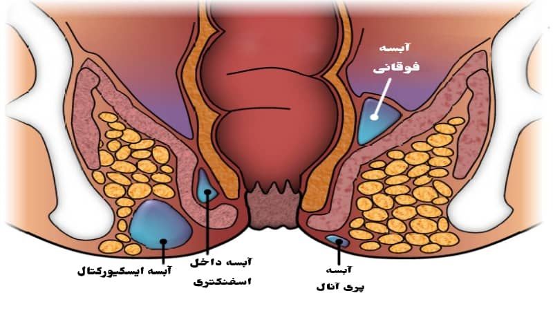 آیا آبسه مقعدی خطرناک است؟ +درمان و علائم