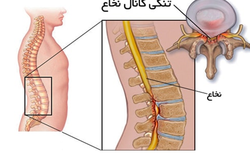 تجربه عمل رفع تنگی کانال نخاعی کمر + فیلم نحوه جراحی