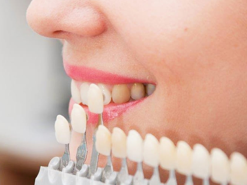 بررسی طول عمر لمینت سرامیکی بررسی طول عمر لمینت سرامیکی