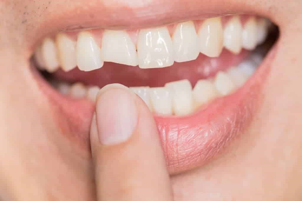 بررسی مزایای کامپوزیت دندان و مقایسه آن با دیگر روش ها