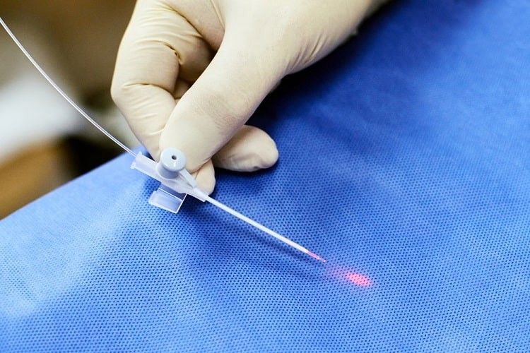 جراحی و درمان واریس با لیزر: مزایا، عوارض و نتایج آن
