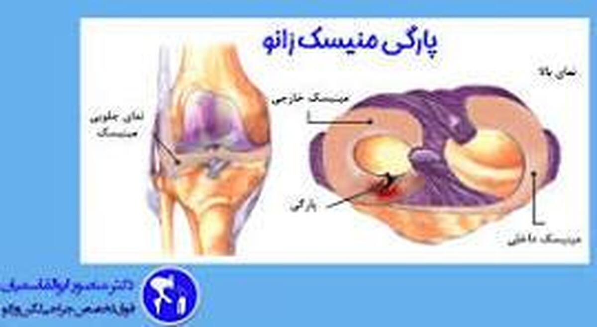 پاره شدن رباط صلیبی قدامی شایع‌ترین آسیب‌ زانو در ورزشکاران