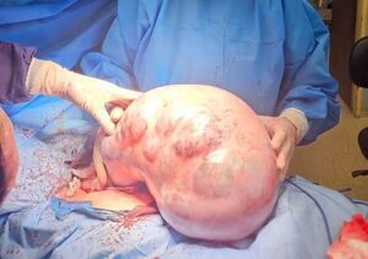 خارج کردن توده ۱۰ کیلویی از شکم یک بیمار در کرج +عکس