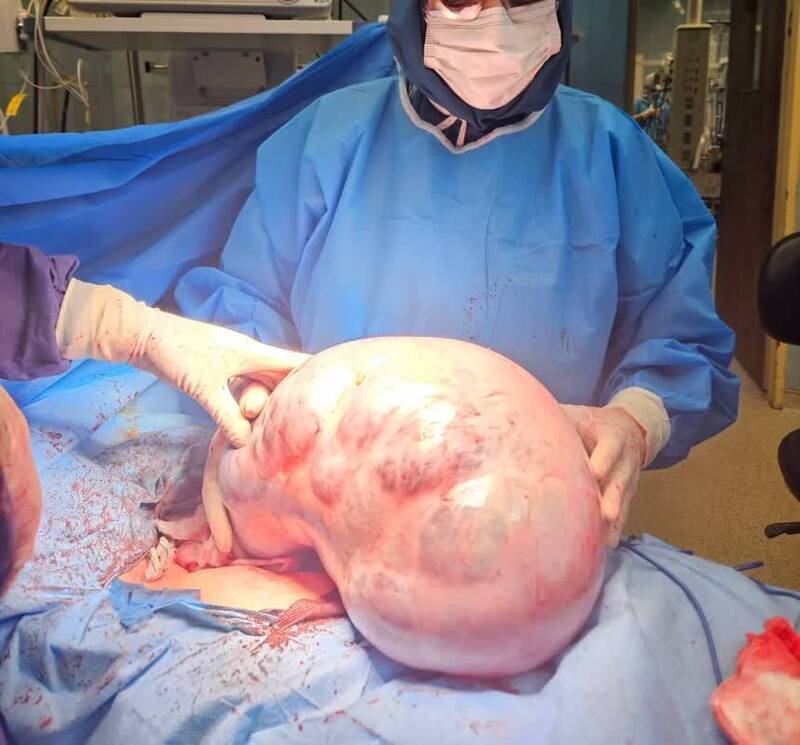 خارج کردن توده ۱۰ کیلویی از شکم یک بیمار در کرج +عکس خارج کردن توده ۱۰ کیلویی از شکم یک بیمار در کرج +عکس