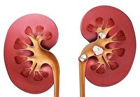 بیماری مزمن کلیه نهمین علت مرگ در جهان شد