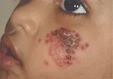 تمام مراحل پیشگیری از بیماری سالک در دامغان انجام شد