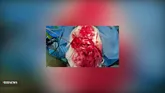 جراحی همزمان تومور مغزی و سزارین