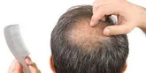 عامل اصلی ریزش مو از نظر طب سنتی