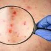 تاکنون مورد مشکوکی از بیماری ابله میمونی در استان مشاهده نشده است